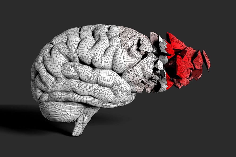 Brain-Injury-Visual-scaled brain injury 3d graphic